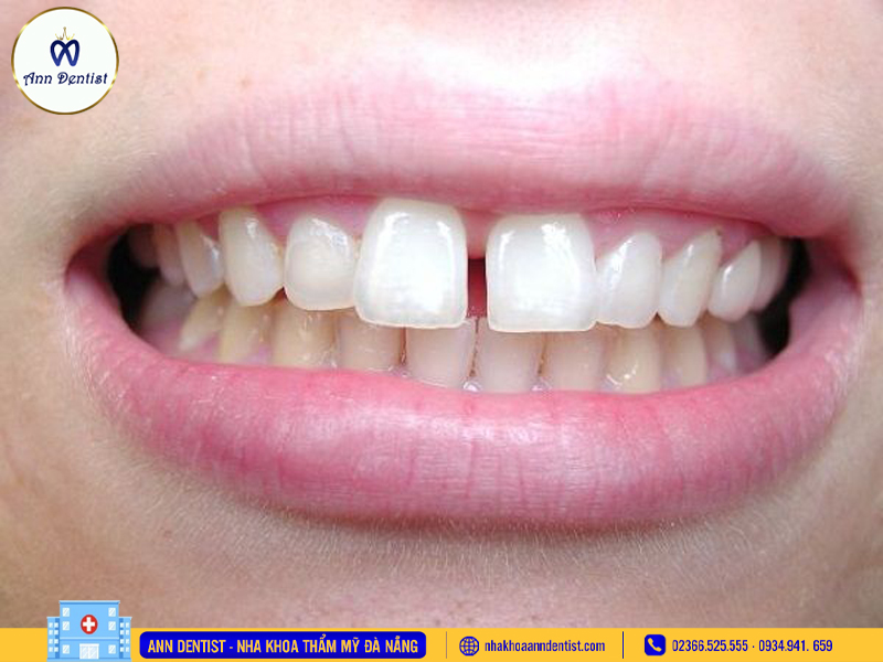 Dán sứ là gì? - Ann Dentist