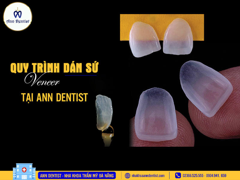 Quy trình dán sứ Veneer tại Ann Dentist.