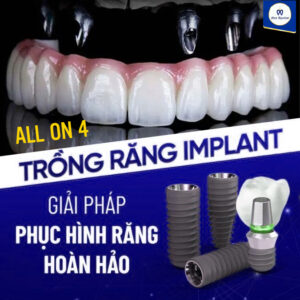 Trồng răng Implant All On 4 Tại Ann Dentist.