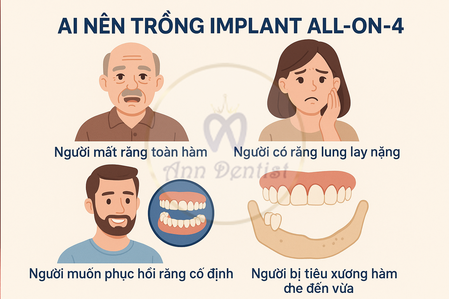 Ai nên trồng răng Implant All-on-4 - Ann Dentist.