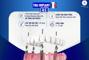 Lợi ích khi trồng trụ implant ETK.