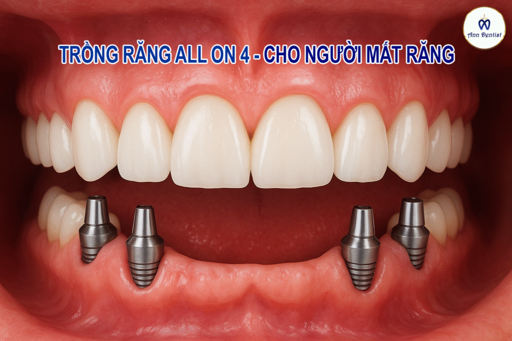 Trồng răng All - on 4 - Ann Dentist
