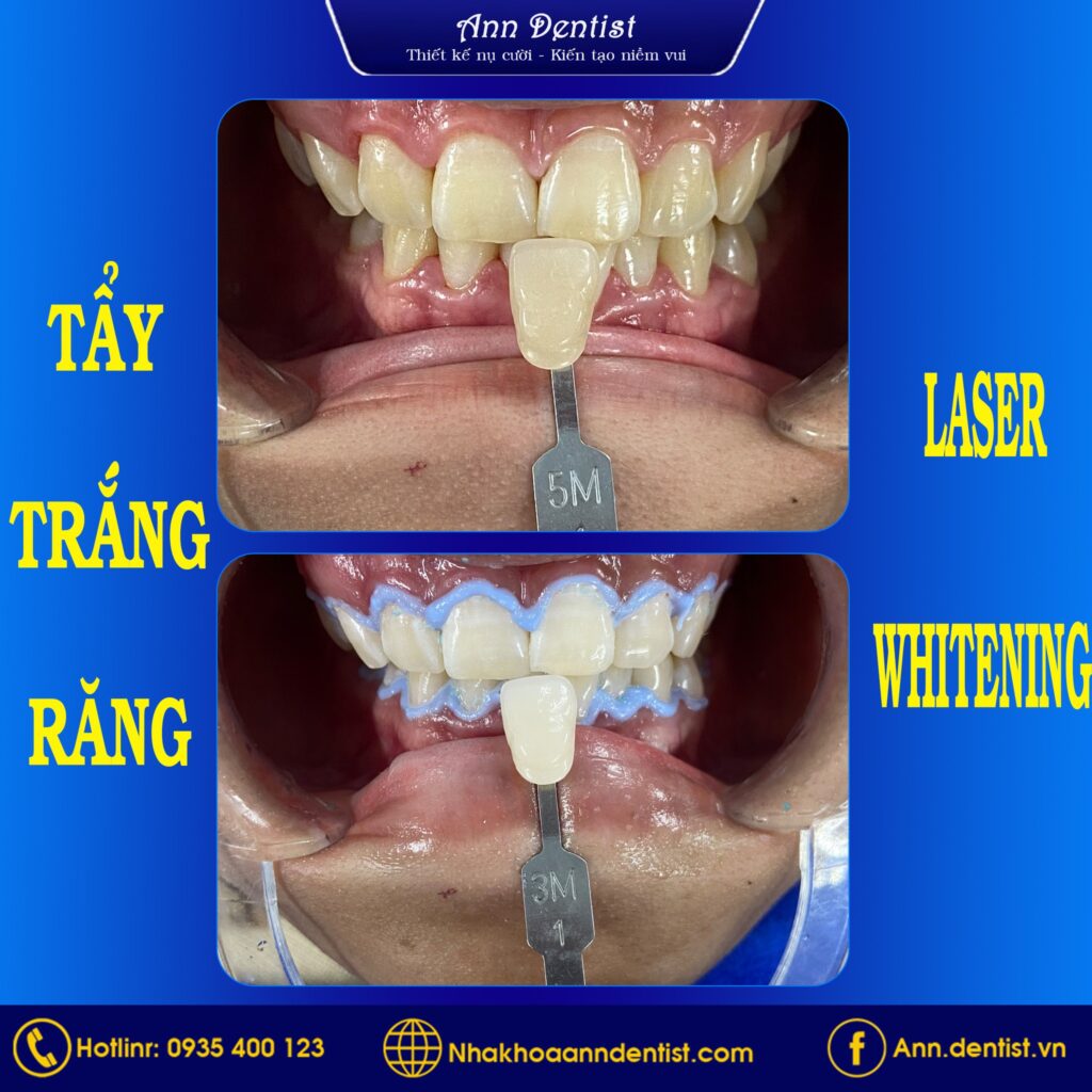 Khách hàng tự tin với nụ cười trắng sáng sau khi tẩy trắng răng tại Ann Dentist.
