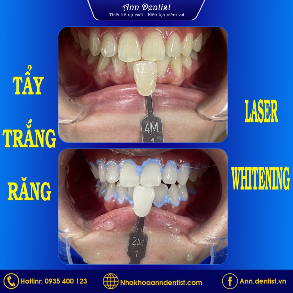 Trước và sau khi tẩy trắng răng tại Ann Dentist – Nha khoa Đà Nẵng.