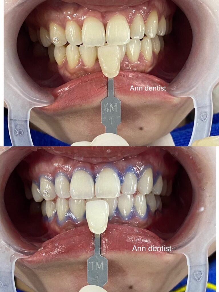 Khách hàng tự tin với nụ cười trắng sáng sau khi tẩy trắng răng tại Ann Dentist.