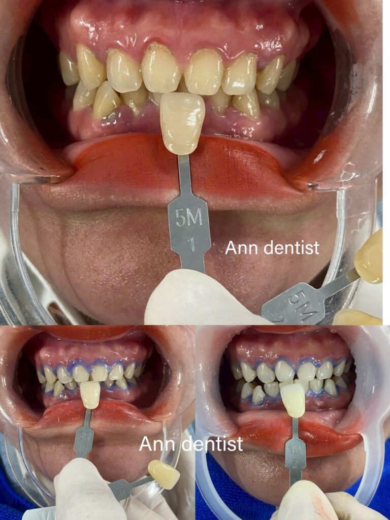 Khách hàng tự tin với nụ cười trắng sáng sau khi tẩy trắng răng tại Ann Dentist.