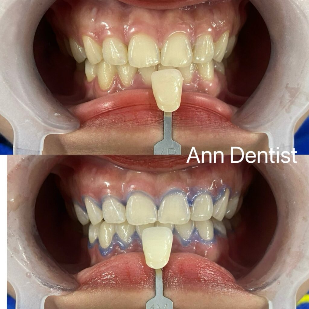 Khách hàng tự tin với nụ cười trắng sáng sau khi tẩy trắng răng tại Ann Dentist.