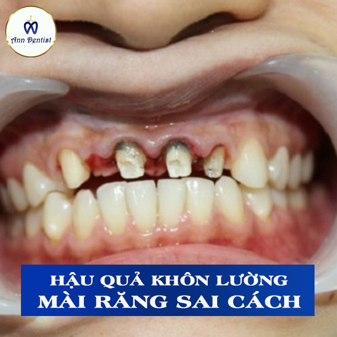 hậu quả mài răng bọc sứ quá mức gây tổn thương tủy