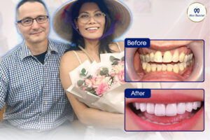 Hình ảnh trước và sau khi làm răng sứ tại Ann Dentist