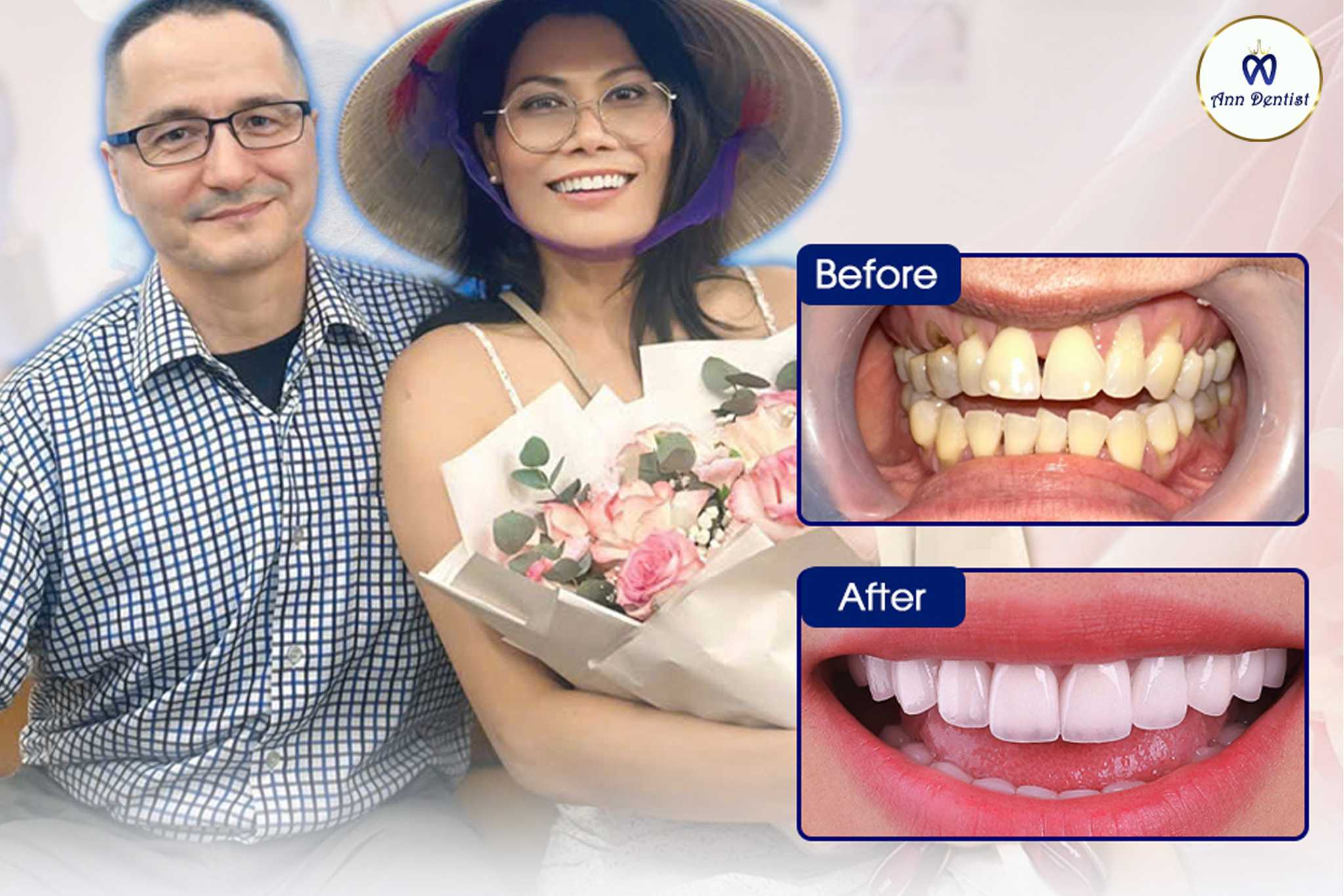 Hình ảnh trước và sau khi làm răng sứ tại Ann Dentist