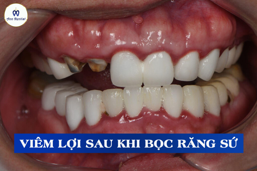 Hình ảnh viêm lợi do kỹ thuật mài răng dưới lợi sai tiêu chuẩn