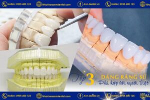 3 Dáng răng sứ phù hợp với người Việt