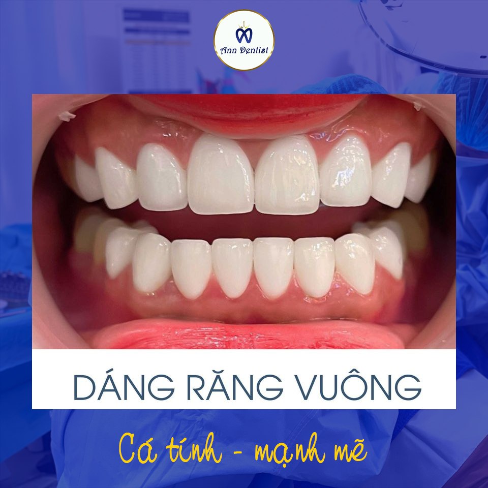 Dáng răng vuông (Cung Đình Style)- Răng sứ phong thủy tại Ann Dentist.