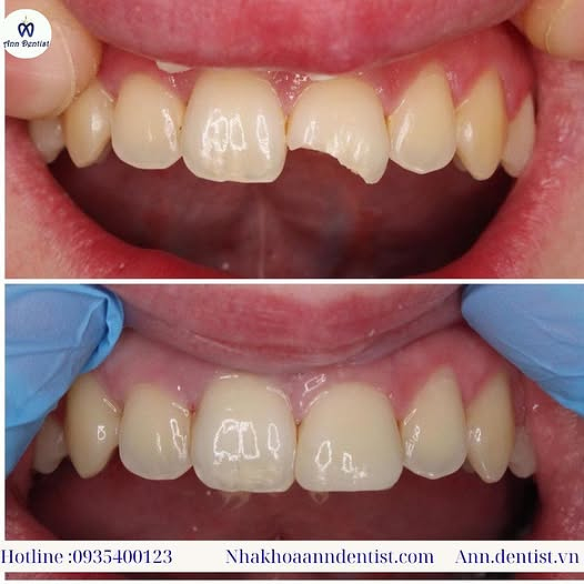 Trám răng mẻ bằng vật liệu composite bền đẹp như răng thật.