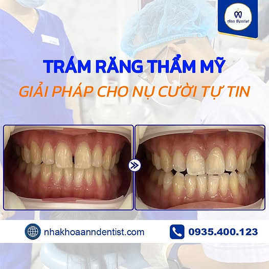 Kết quả trám răng composite thẩm mỹ cho răng cửa bị thưa.