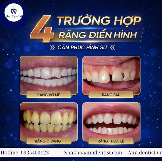 Những trường hợp nên bọc răng sứ.