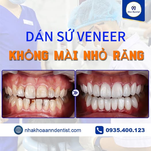 Hình ảnh so sánh Trước & Sau (Before & After) của một ca dán sứ