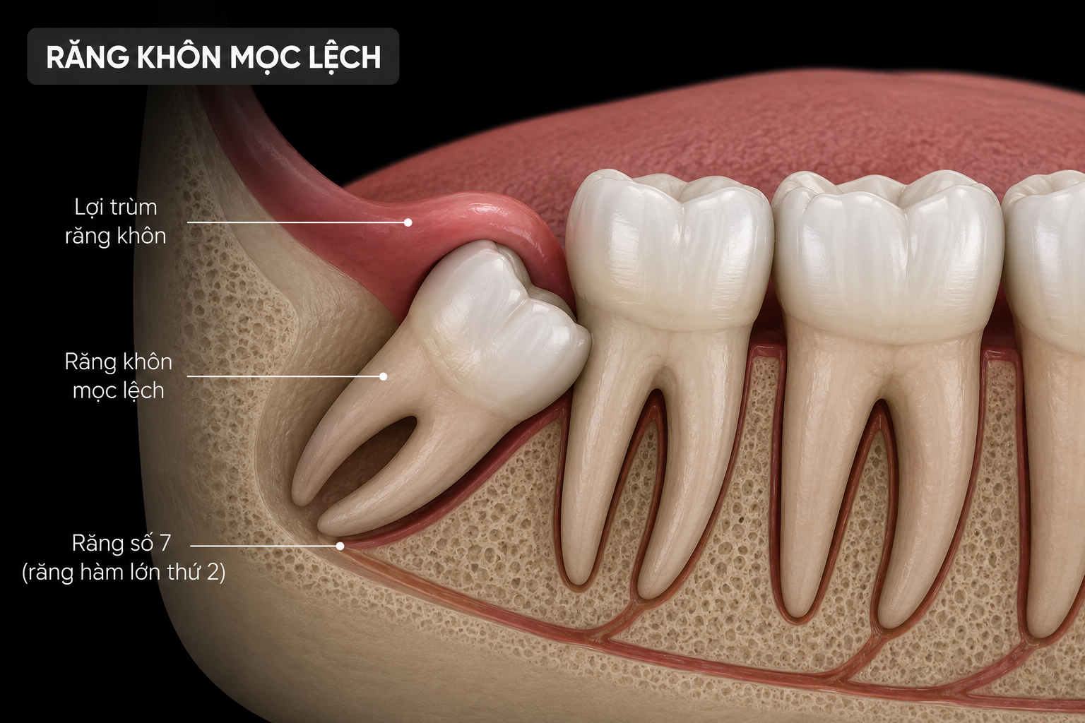 răng khôn mọc lệch theo hướng ngang, chèn ép răng hàm số 7 và gây viêm lợi trùm