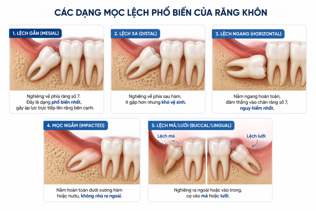 tình trạng mọc lệch do thiếu khoảng trống trên cung hàm, gây đau nhức