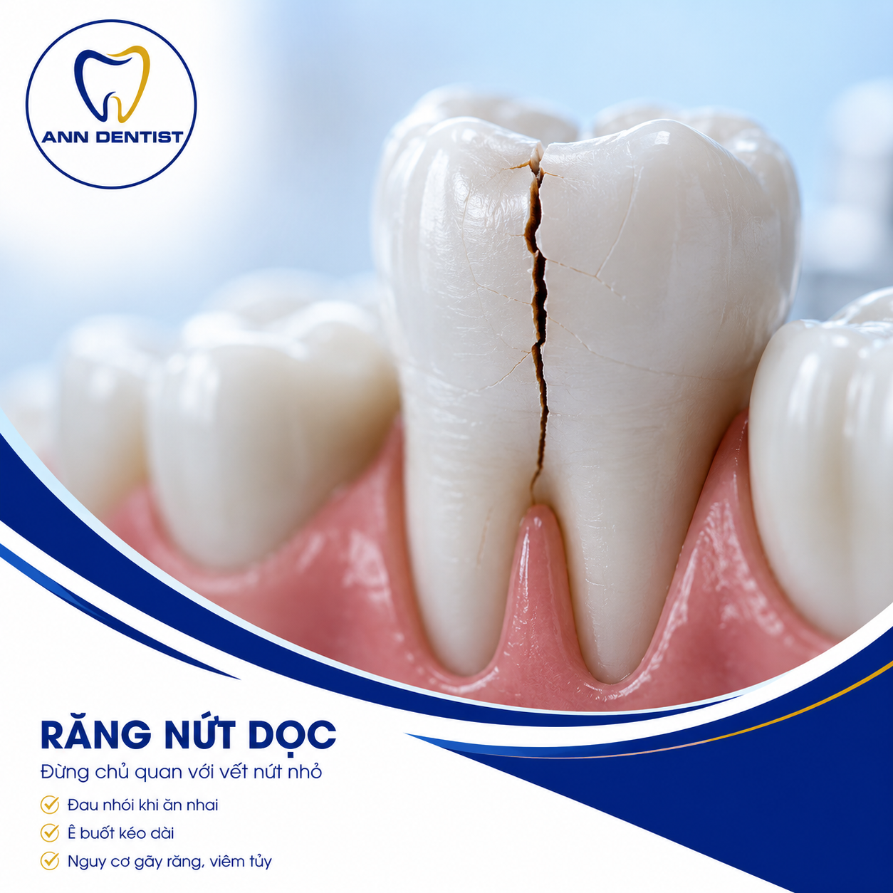 Răng nứt dọc. Đau nhói khi ăn nhai? Ê buốt kéo dài? Đó có thể là dấu hiệu của răng nứt dọc. Đừng chờ đến khi vết nứt lan rộng gây viêm tủy hoặc gãy răng.