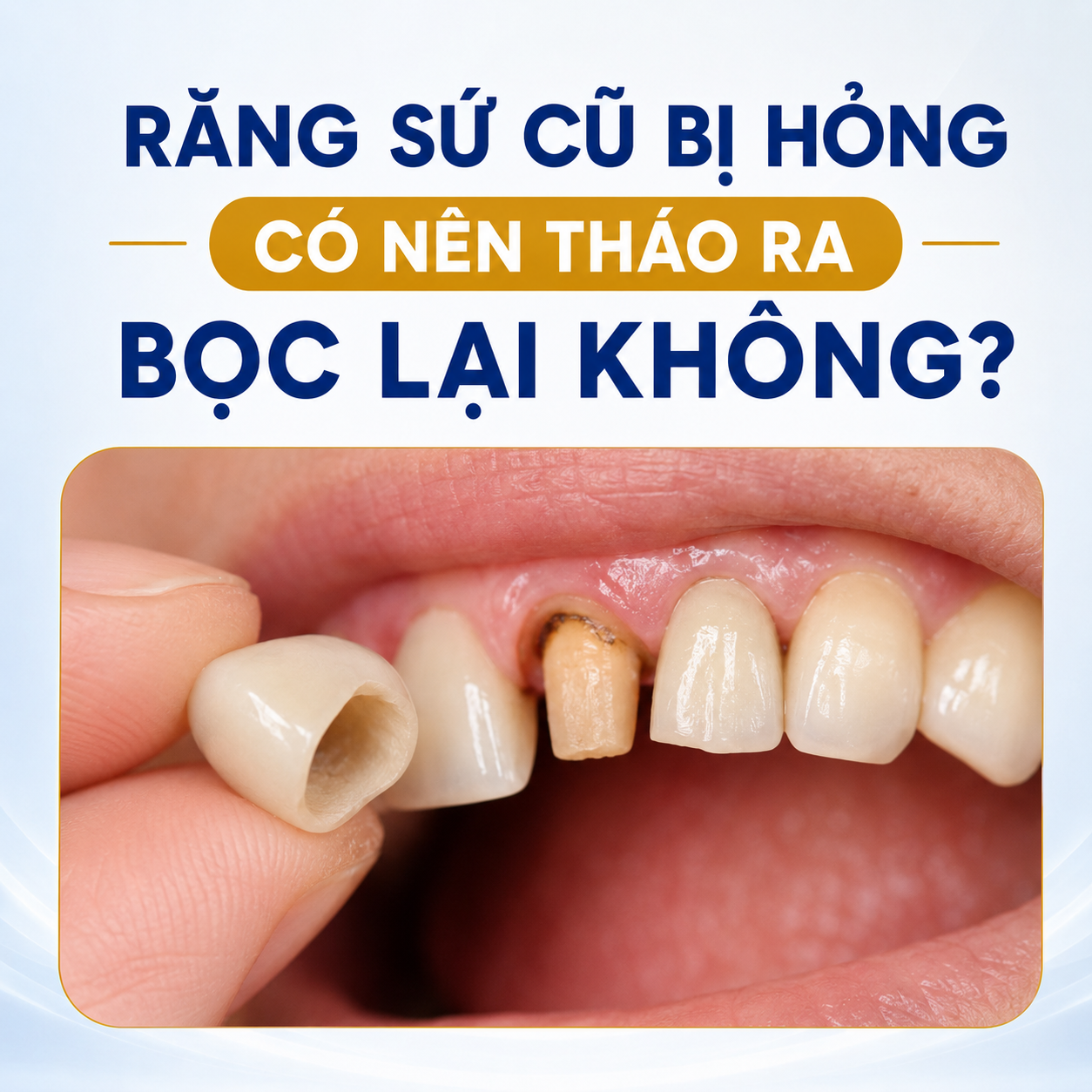 Răng sứ không thể sử dụng vĩnh viễn. Sau một thời gian, hoặc do va đập, kỹ thuật bọc sứ ban đầu không đảm bảo hay vệ sinh răng miệng chưa đúng cách, răng sứ có thể bị nứt, mẻ, hở viền, đổi màu hoặc gây đau nhức. Khi đó, việc tiếp tục sử dụng không chỉ làm giảm tính thẩm mỹ mà còn tạo điều kiện cho vi khuẩn xâm nhập, gây sâu răng, viêm tủy và ảnh hưởng đến răng thật bên dưới.