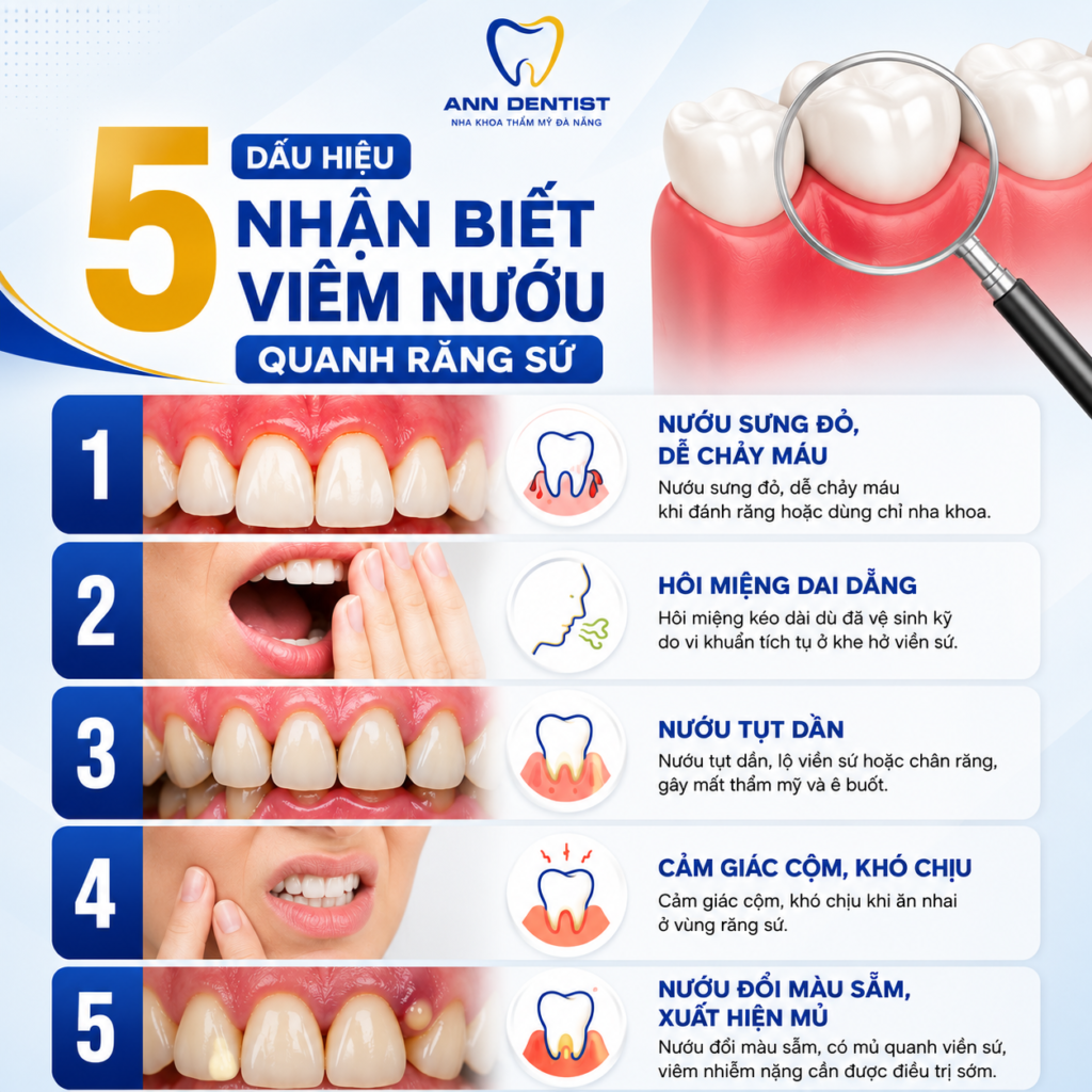 5 dấu hiệu nhận biết viêm nướu quanh răng sứ