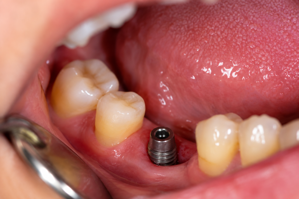 trồng răng implant