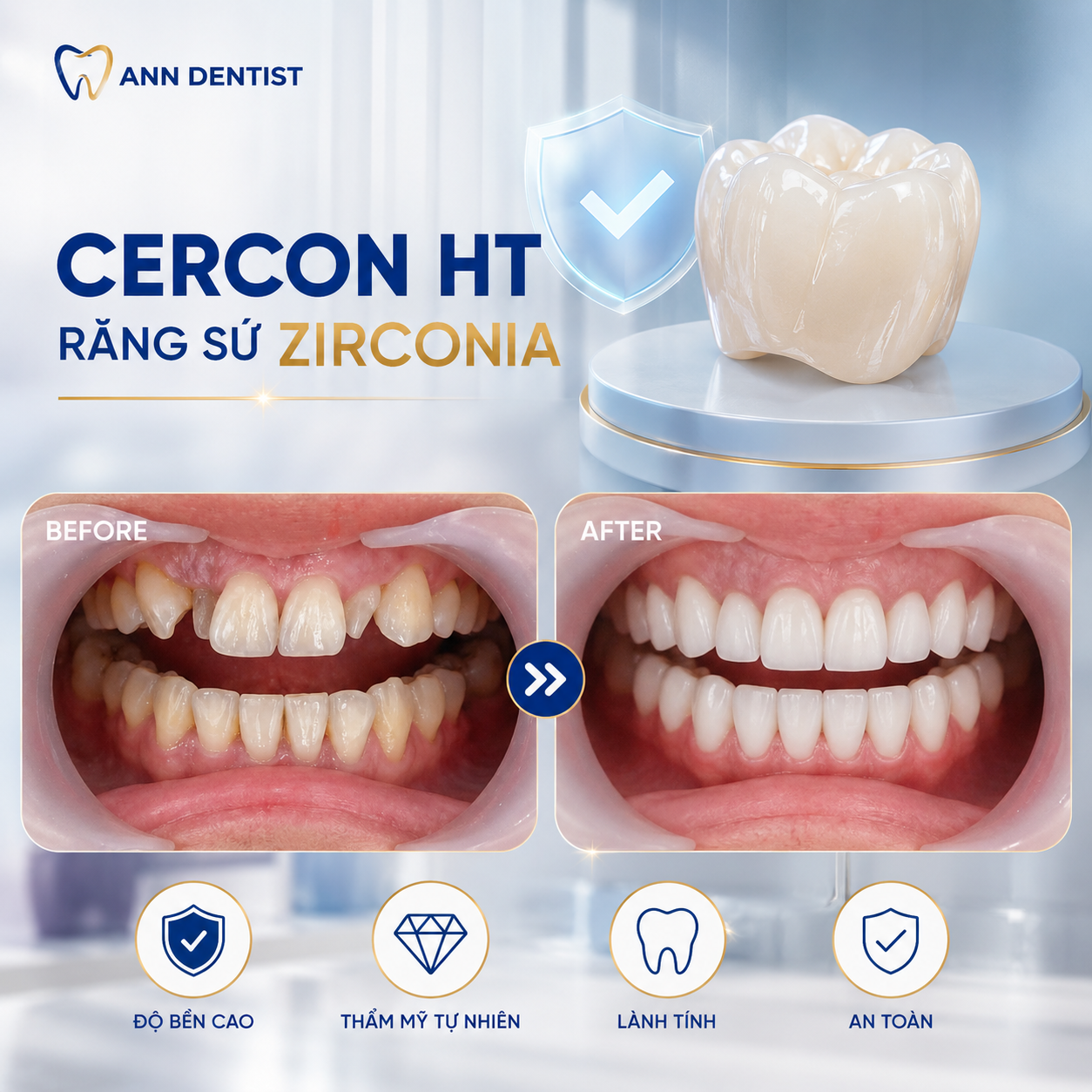 Sứ Zirconia Cercon HT