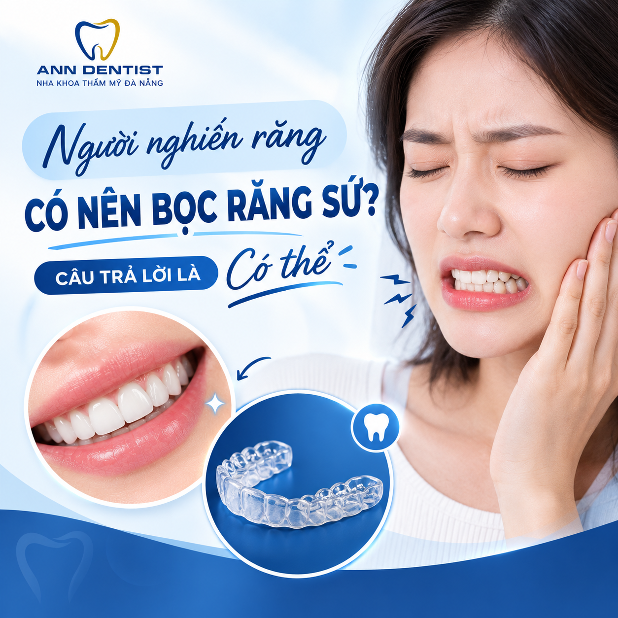 Nghiến răng có nên bọc sứ không?