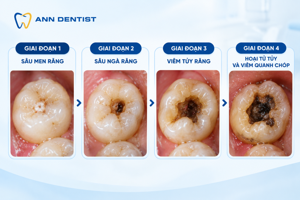 Các giai đoạn sâu răng