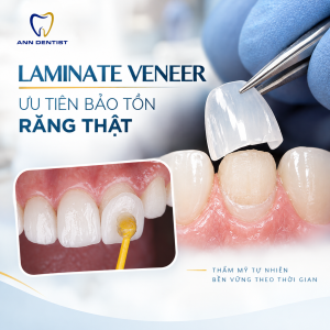laminate veneer